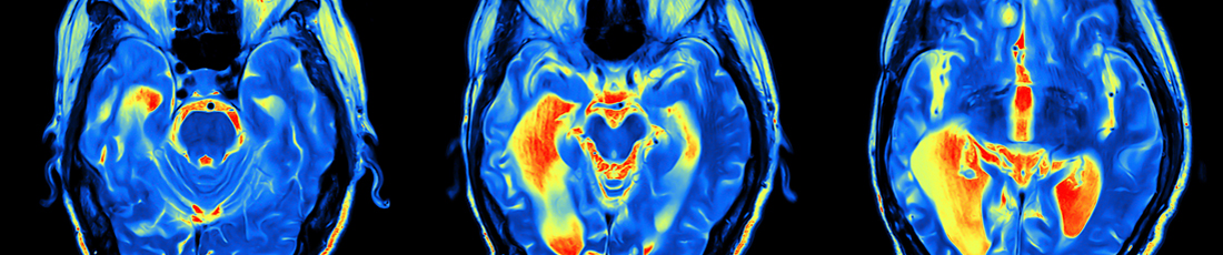 Cerebrovascular And Endovascular Neurosurgery